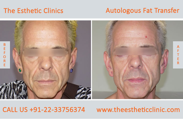 Autologous Fat Transfer, Fat Transfer Grafting, Lipofilling Fat Transfer Surgery before after photos (1 (4)